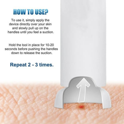 🦟Bug Bite Suction Tool - Relieve itching and swelling✅