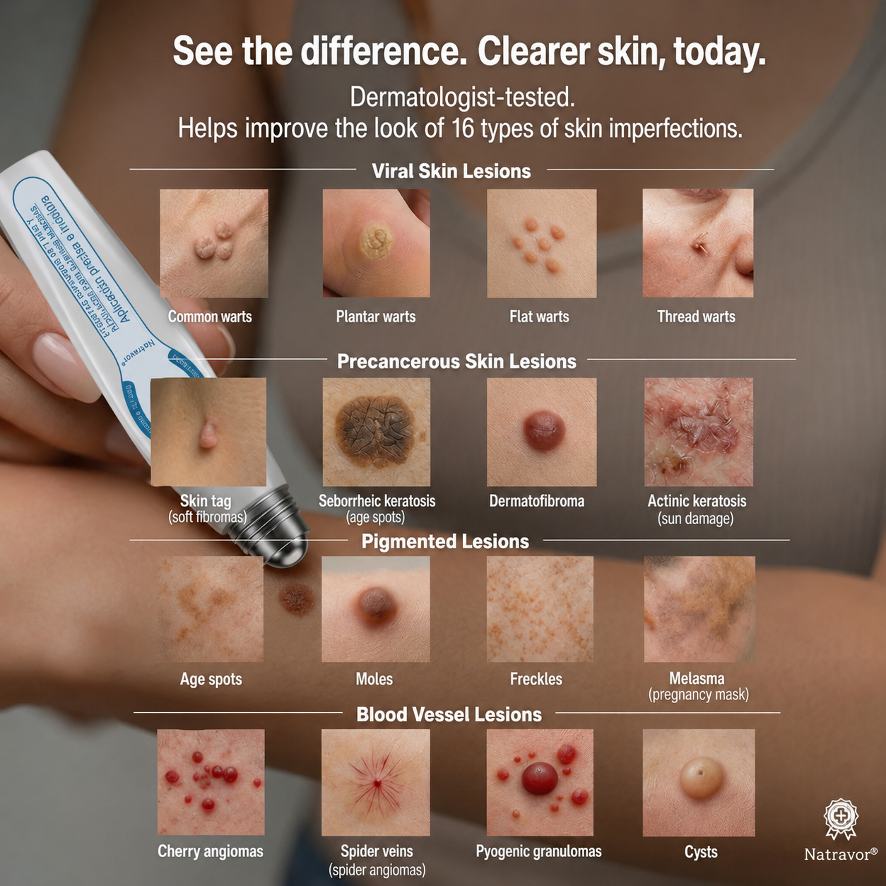 ✨ Official Natravor® Store | 🖊️ 7-Day Tag & Spot Eraser Pen - 🌿 Gentle Precision Roller for Warts, Skin Tags & Spots