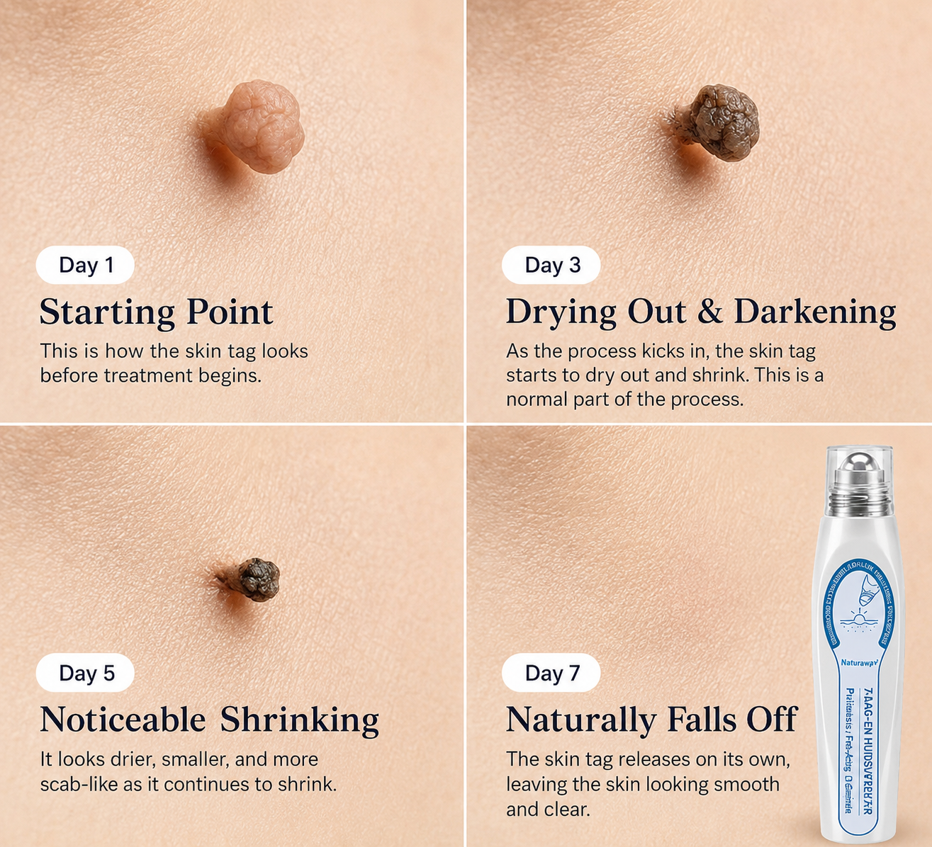 ✨ Official Natravor® Store | 🖊️ 7-Day Tag & Spot Eraser Pen - 🌿 Gentle Precision Roller for Warts, Skin Tags & Spots